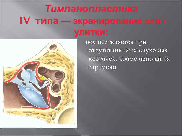 Тимпанопластика IV типа — экранирование окна улитки: осуществляется при отсутствии всех слуховых косточек, кроме