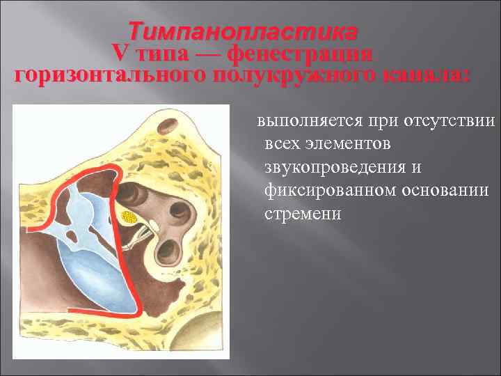 Тимпанопластика V типа — фенестрация горизонтального полукружного канала: выполняется при отсутствии всех элементов звукопроведения