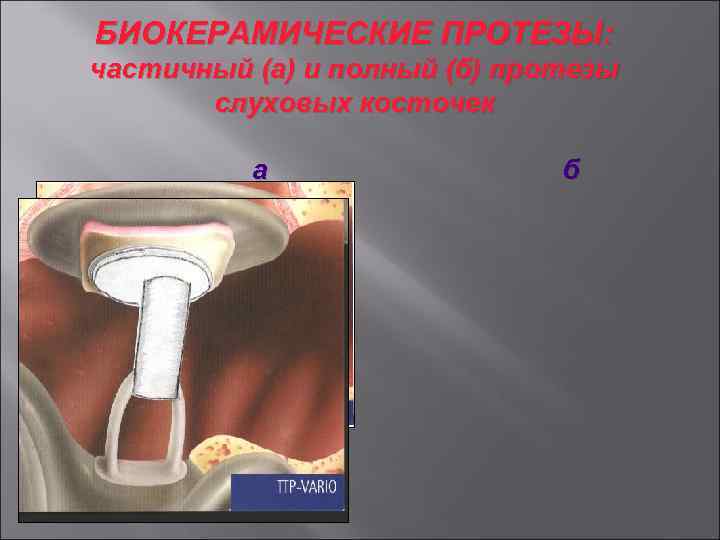 БИОКЕРАМИЧЕСКИЕ ПРОТЕЗЫ: частичный (а) и полный (б) протезы слуховых косточек а б 