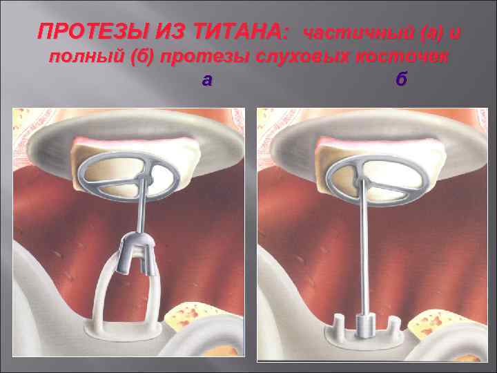 ПРОТЕЗЫ ИЗ ТИТАНА: частичный (а) и полный (б) протезы слуховых косточек а б 