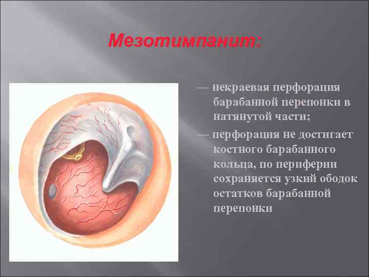 Мезотимпанит: — некраевая перфорация барабанной перепонки в натянутой части; — перфорация не достигает костного