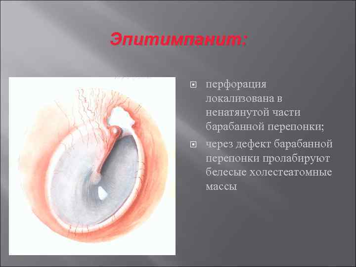 Эпитимпанит: перфорация локализована в ненатянутой части барабанной перепонки; через дефект барабанной перепонки пролабируют белесые
