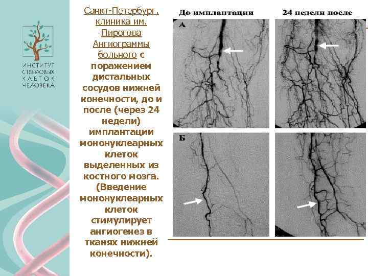 Санкт-Петербург, клиника им. Пирогова Ангиограммы больного с поражением дистальных сосудов нижней конечности, до и