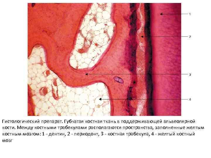 Гистологический препарат. Губчатая костная ткань в поддерживающей альвеолярной кости. Между костными трабекулами располагаются пространства,