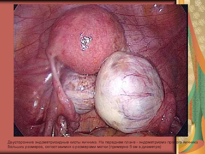 Двусторонние эндометриоидные кисты яичника. На переднем плане - эндометриома правого яичника больших размеров, сопоставимая