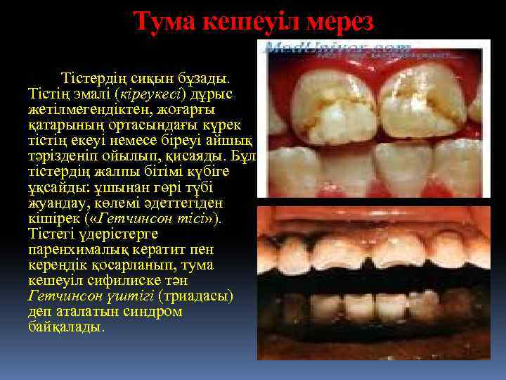 Тума кешеуіл мерез Тістердің сиқын бұзады. Тістің эмалі (кіреукесі) дұрыс жетілмегендіктен, жоғарғы қатарының ортасындағы