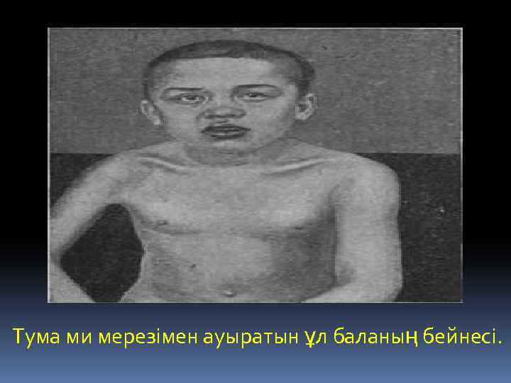 Тума ми мерезімен ауыратын ұл баланың бейнесі. 