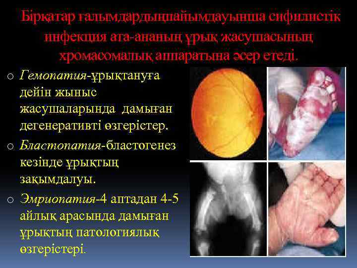  Бірқатар ғалымдардыңпайымдауынша сифилистік инфекция ата-ананың ұрық жасушасының хромасомалық аппаратына әсер етеді. o Гемопатия-ұрықтануға