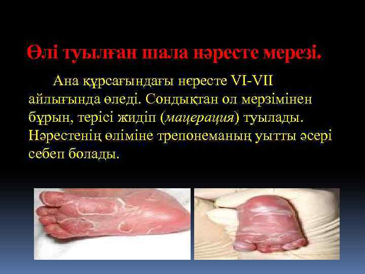 Өлі туылған шала нәресте мерезі. Ана құрсағындағы нєресте VI-VII айлығында өледі. Сондықтан ол мерзімінен