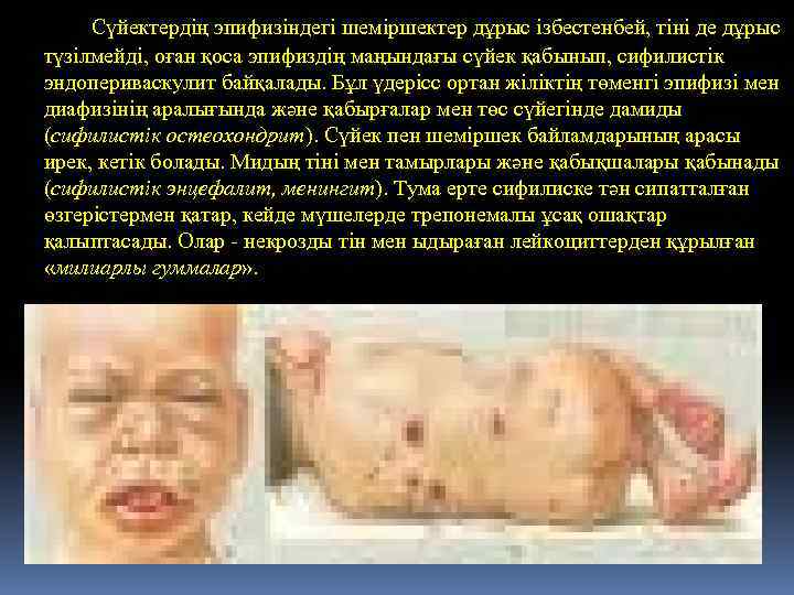  Сүйектердің эпифизіндегі шеміршектер дұрыс ізбестенбей, тіні де дұрыс түзілмейді, оған қоса эпифиздің маңындағы