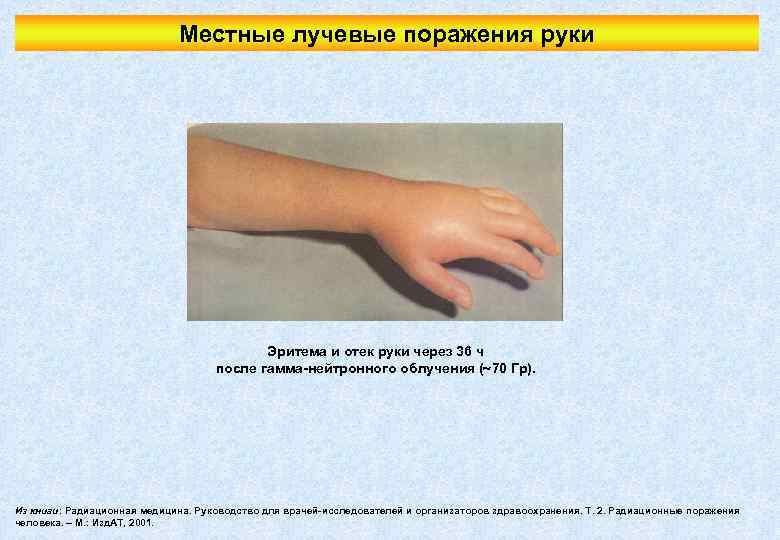 Местные лучевые поражения руки Эритема и отек руки через 36 ч после гамма-нейтронного облучения