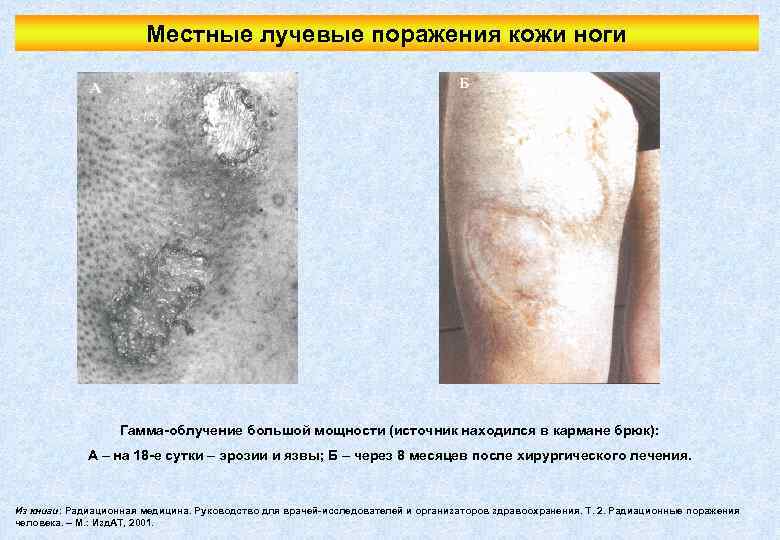 Местные лучевые поражения кожи ноги Гамма-облучение большой мощности (источник находился в кармане брюк): А