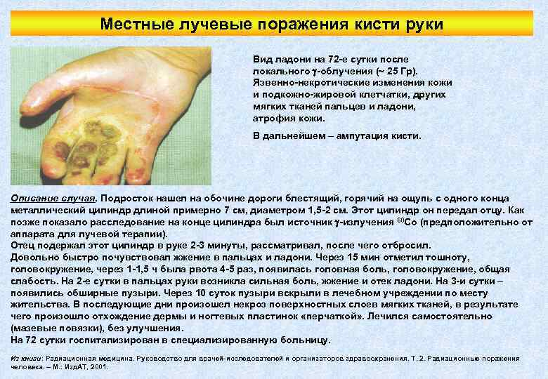 Местные лучевые поражения кисти руки Вид ладони на 72 -е сутки после локального -облучения