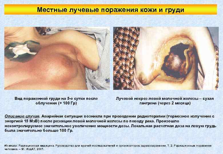 Местные лучевые поражения кожи и груди Вид пораженной груди на 5 -е сутки после