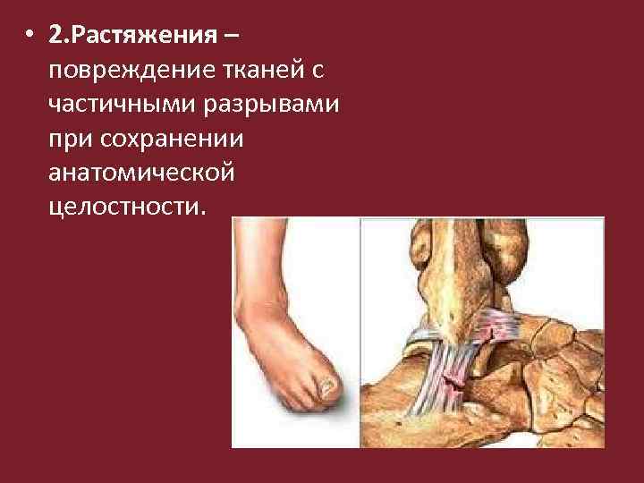  • 2. Растяжения – повреждение тканей с частичными разрывами при сохранении анатомической целостности.