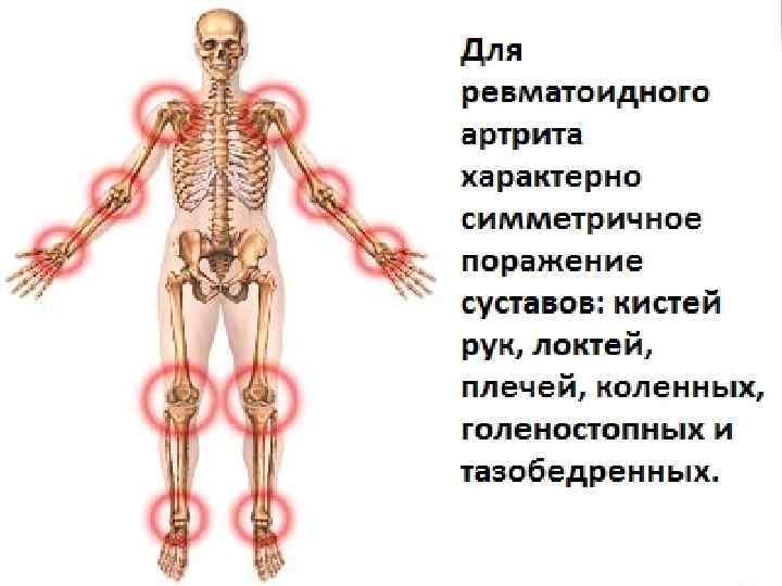 Prevenir artritis