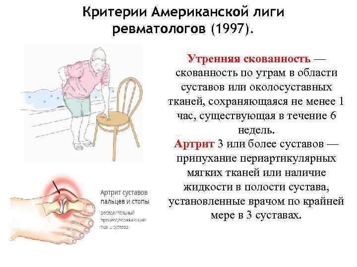 Критерии Американской лиги ревматологов (1997). Утренняя скованность — скованность по утрам в области суставов