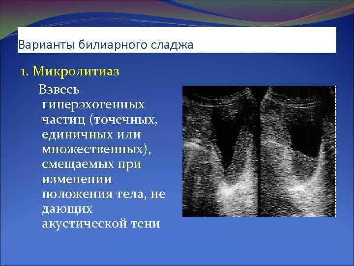 Гиперэхогенный фокус. Микролитиаз желчного пузыря. Билиарный сладж в желчном пузыре. Сладж-синдром желчного пузыря на УЗИ.