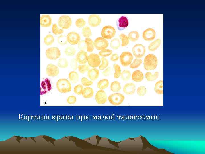 Картина крови при малой талассемии 