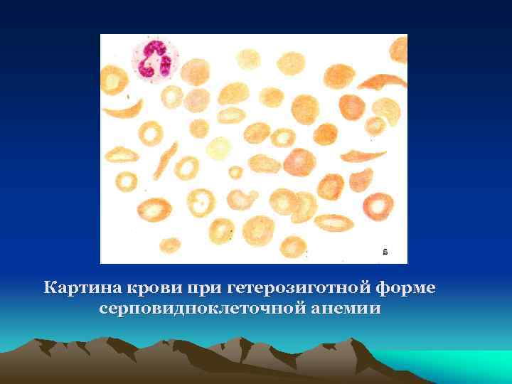 Картина крови при гетерозиготной форме серповидноклеточной анемии 