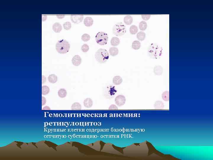 Гемолитическая анемия: ретикулоцитоз Крупные клетки содержат базофильную сетчатую субстанцию- остатки РНК. 