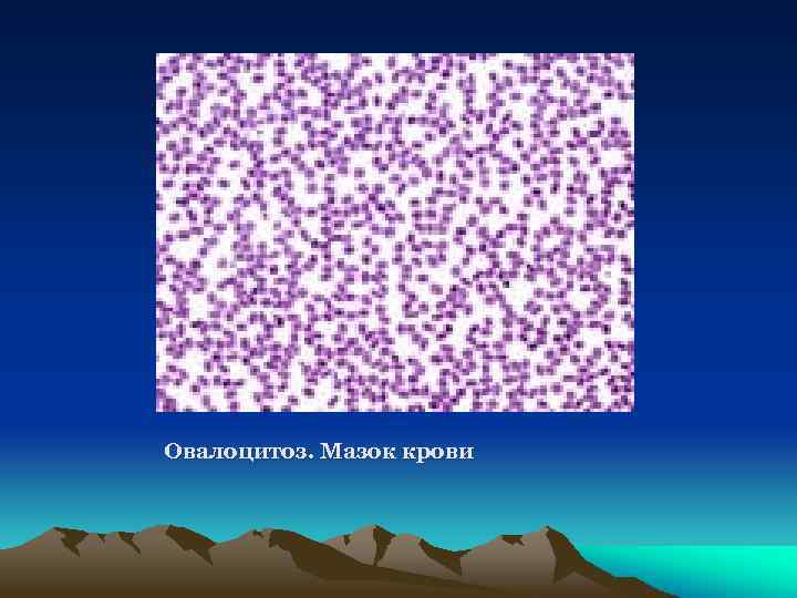 Овалоцитоз. Мазок крови 