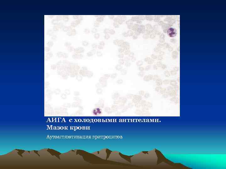 АИГА с холодовыми антителами. Мазок крови Аутоагглютинация эритроцитов 