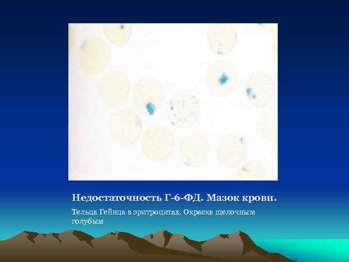 Недостаточность Г-6 -ФД. Мазок крови. Тельца Гейнца в эритроцитах. Окраска щелочным голубым 