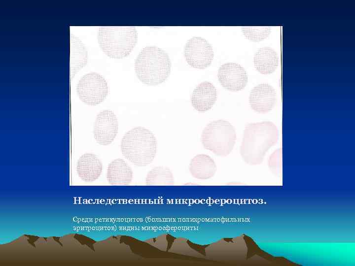 Наследственный микросфероцитоз. Среди ретикулоцитов (больших полихроматофильных эритроцитов) видны микросфероциты 