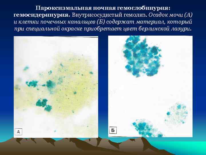 Пароксизмальная ночная гемоглобинурия презентация