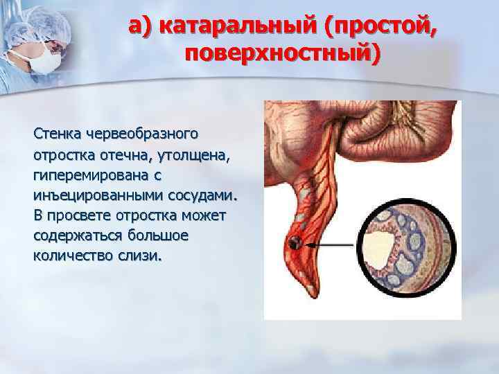 а) катаральный (простой, поверхностный) Стенка червеобразного отростка отечна, утолщена, гиперемирована с инъецированными сосудами. В