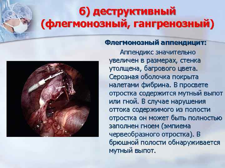 б) деструктивный (флегмонозный, гангренозный) Флегмонозный аппендицит: Аппендикс значительно увеличен в размерах, стенка утолщена, багрового