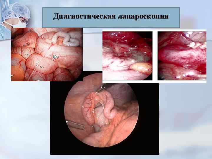 Диагностическая лапароскопия 