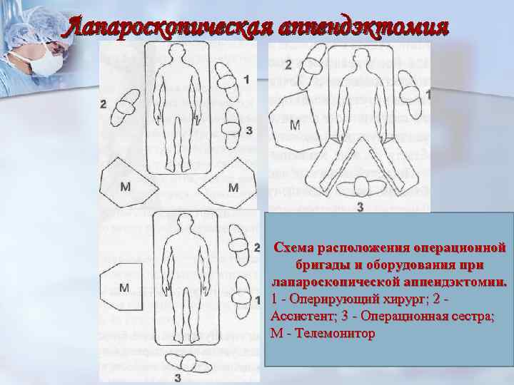 Лапароскопическая аппендэктомия Схема расположения операционной бригады и оборудования при лапароскопической аппендэктомии. 1 - Оперирующий