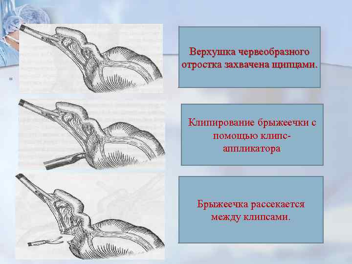 Верхушка червеобразного отростка захвачена щипцами. n Производится фенестрация брыжеечки диссектором Клипирование брыжеечки с помощью