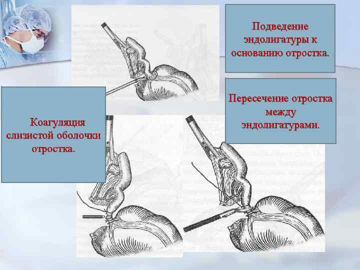 Подведение эндолигатуры к основанию отростка. Коагуляция слизистой оболочки отростка. Пересечение отростка между эндолигатурами. 