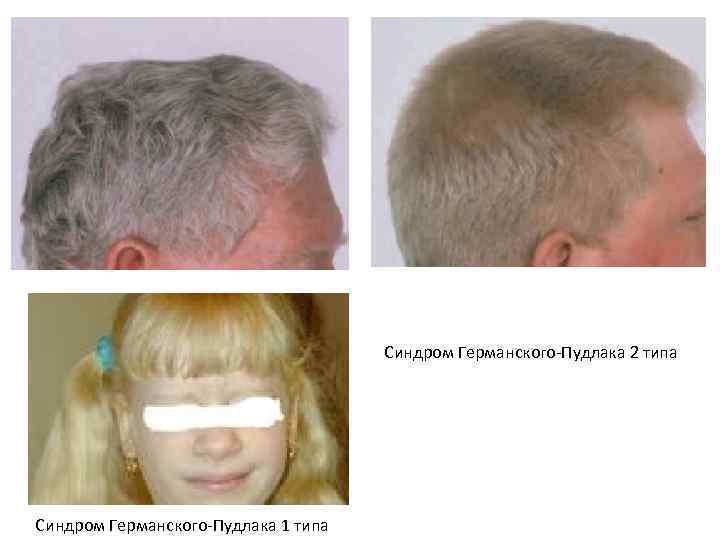 Синдром Германского-Пудлака 2 типа Синдром Германского-Пудлака 1 типа 