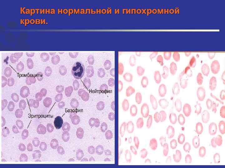 Картина нормальной и гипохромной крови. 