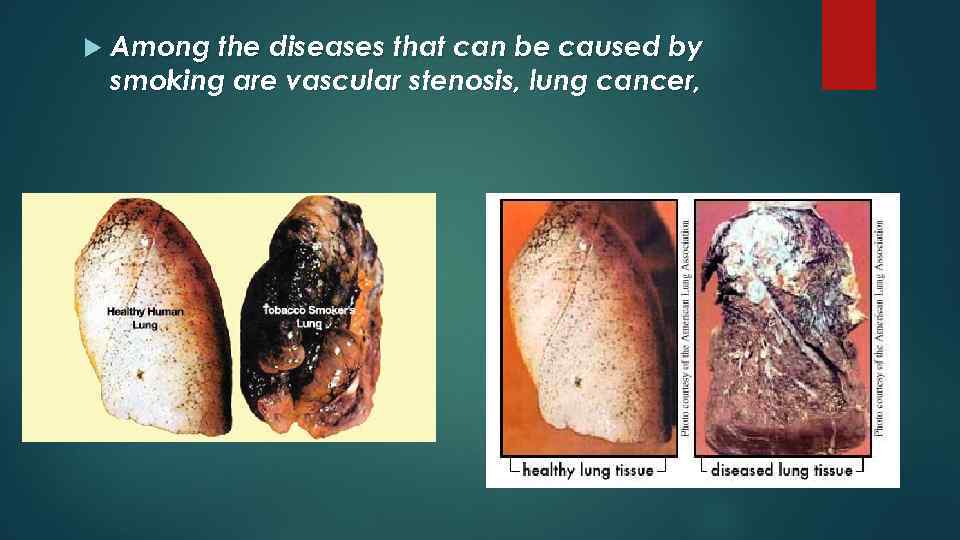  Among the diseases that can be caused by smoking are vascular stenosis, lung