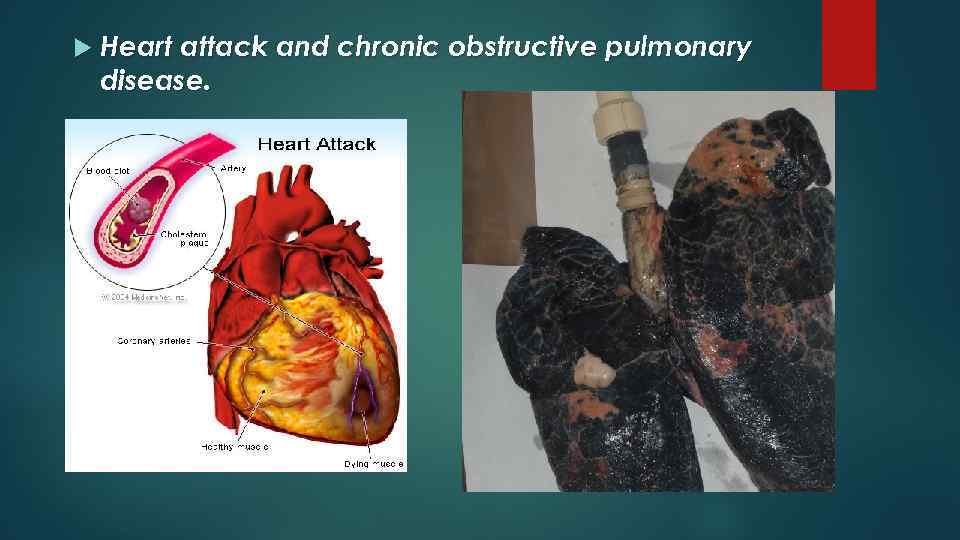  Heart attack and chronic obstructive pulmonary disease. 