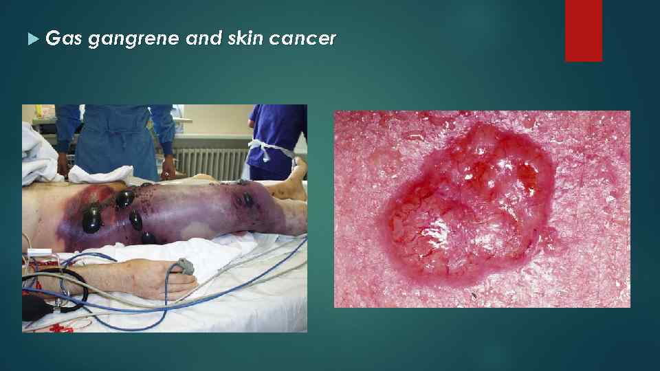  Gas gangrene and skin cancer 