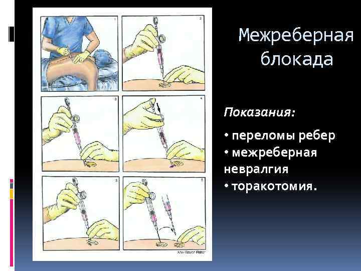 Блокады при переломах. Межреберная новокаиновая блокада показания техника. Новокаиновые блокады перелом ребер. Межреберная невралгия блокады. Блокада нерва при межреберной невралгии.