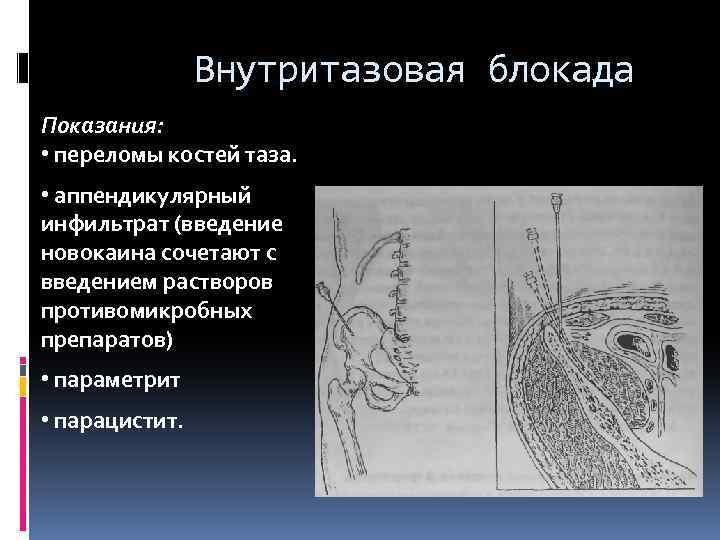 Внутритазовая блокада Показания: • переломы костей таза. • аппендикулярный инфильтрат (введение новокаина сочетают с