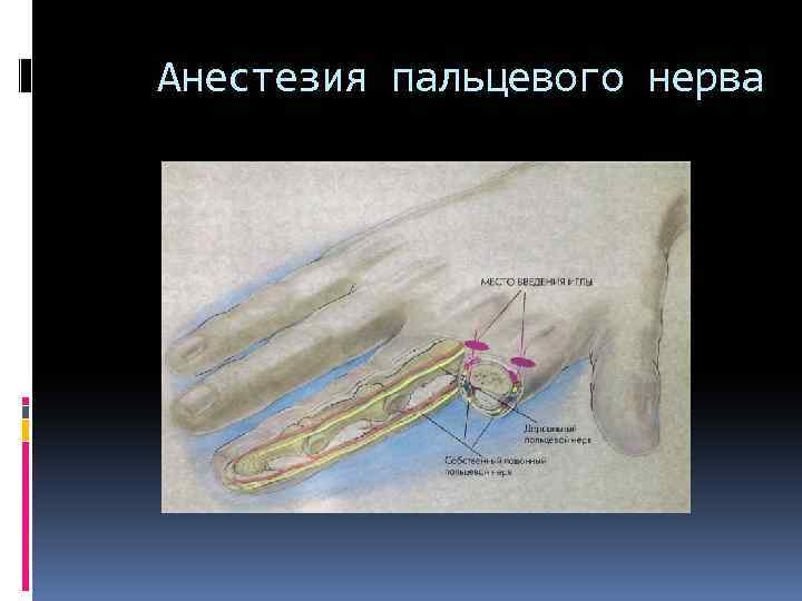 Анестезия пальцевого нерва 