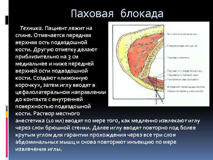 Паховая блокада Техника. Пациент лежит на спине. Отмечается передняя верхняя ость подвздошной кости. Другую