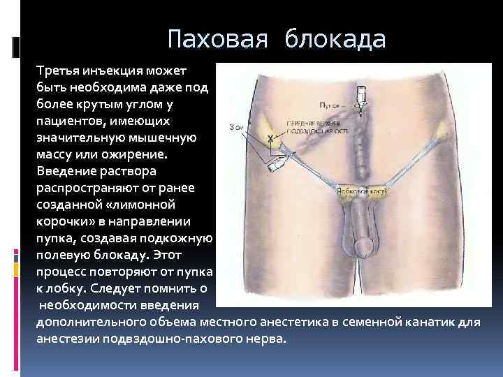 Паховая блокада Третья инъекция может быть необходима даже под более крутым углом у пациентов,