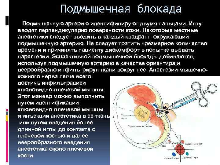 Подмышечная блокада Подмышечную артерию идентифицируют двумя пальцами. Иглу вводят перпендикулярно поверхности кожи. Некоторые местные