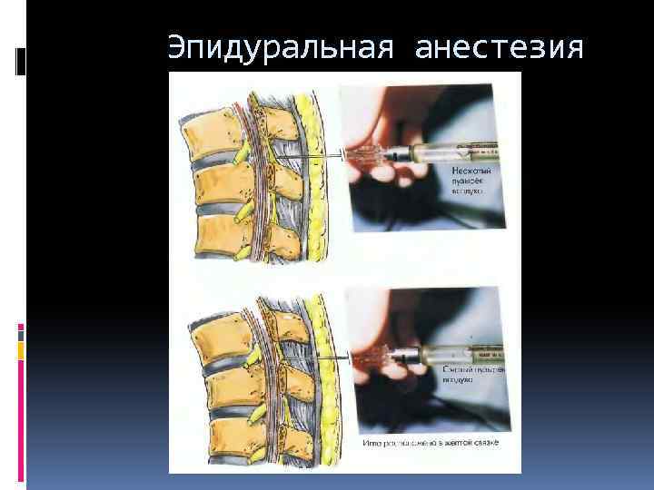 Эпидуральная анестезия 