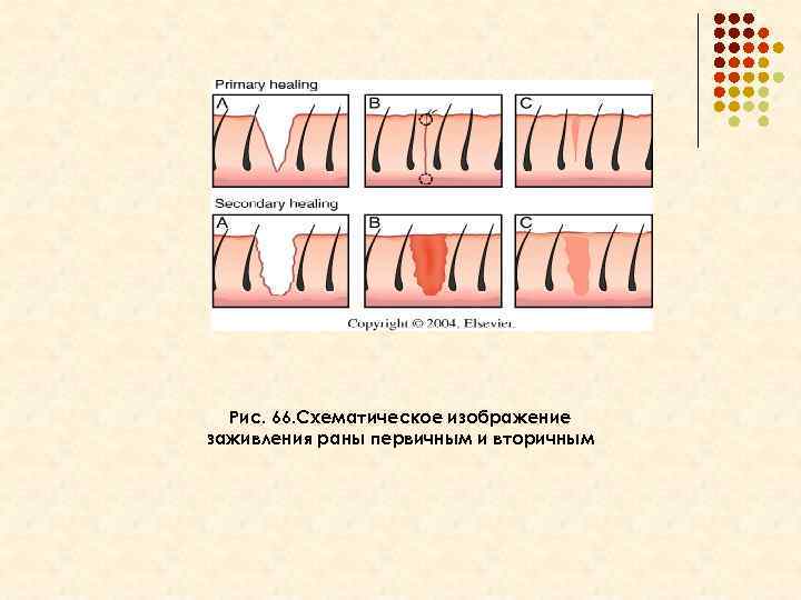 Рис. 66. Схематическое изображение заживления раны первичным и вторичным 