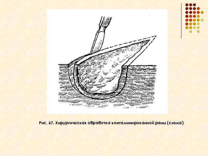 Рис. 67. Хирургическая обработка контаминированной раны (схема) 